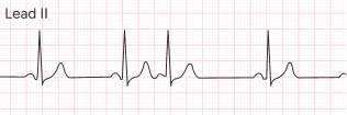 Atrial Ectopics