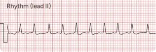 Atrial Fibrillation
