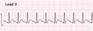 Atrial Tachycardia