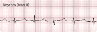 Junctional Rhythm