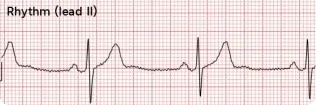 Sinus Bradycardia