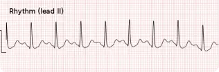 Sinus Tachycardia