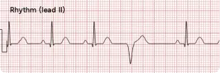 Ventricular Ectopics