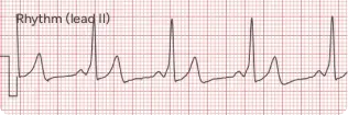 WPW Syndrome