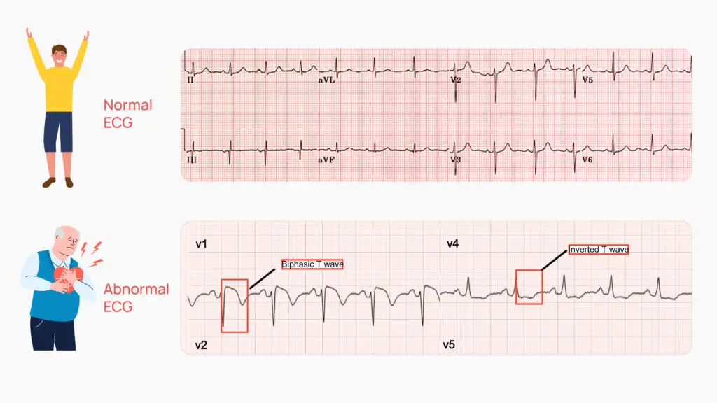 What does Normal ECG and Abnormal ECG mean?