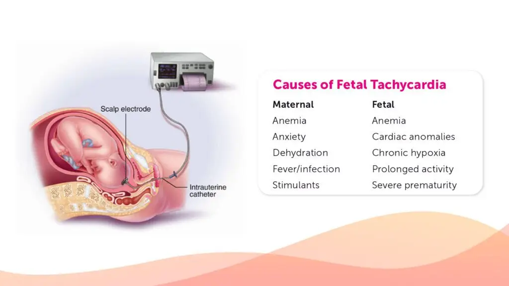 Fetal Tachycardia: symptoms, causes, treatment