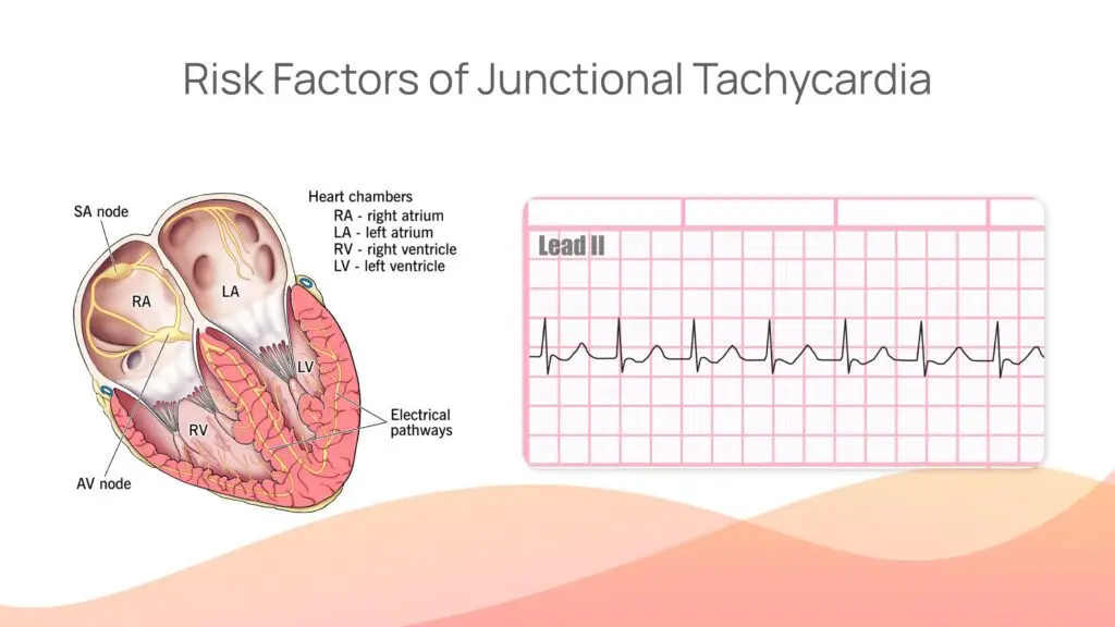 What are the causes and Risk Factors of Junctional Tachycardia?