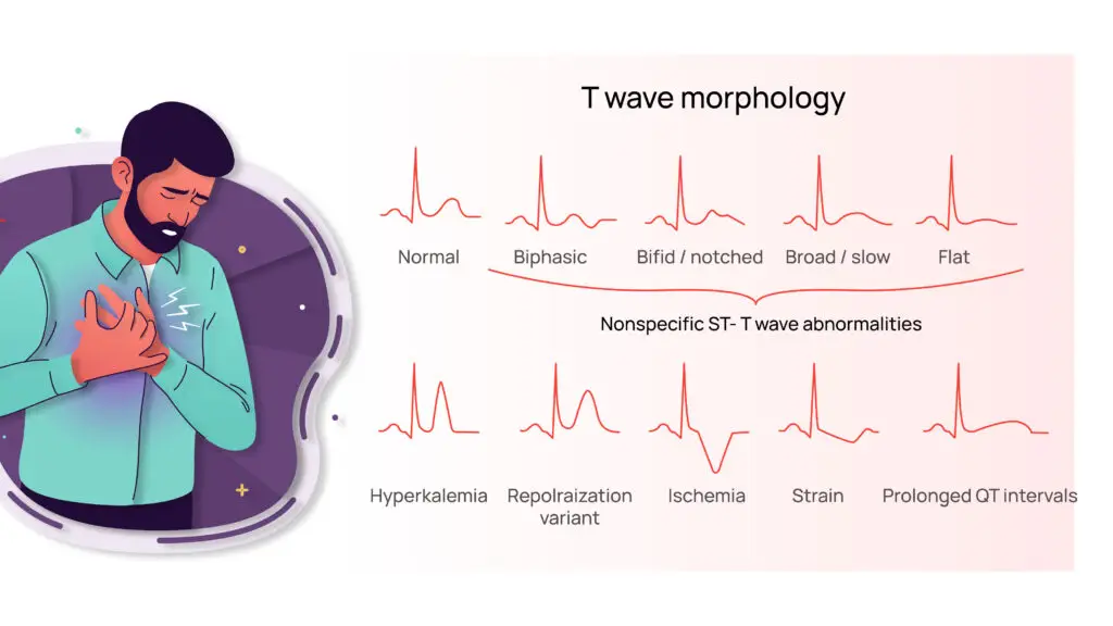 Understanding T Wave Abnormality: Symptoms, causes and treatment