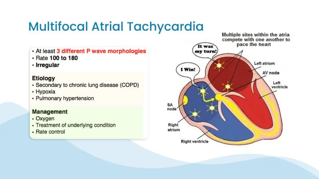 Multifocal Atrial Tachycardia: Recognizing Signs and Symptoms