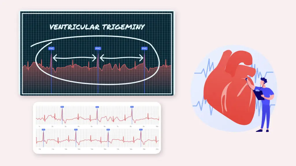 Understanding the Significance of Ventricular Trigeminy in Heart Health