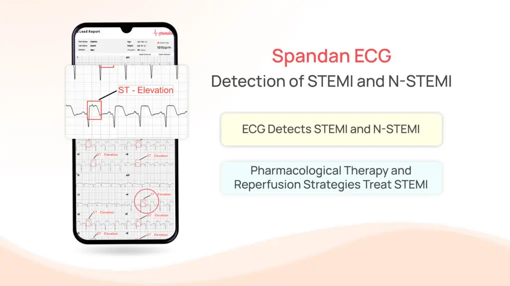 Spandan ECG: Ischemic Heart Disease Pathophysiology & STEMI Detection