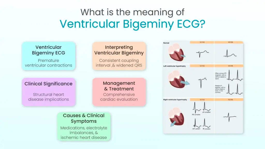 What is the meaning of Ventricular Bigeminy ECG?
