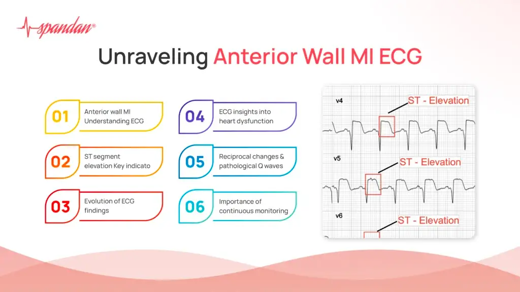 Unraveling Anterior Wall MI ECG