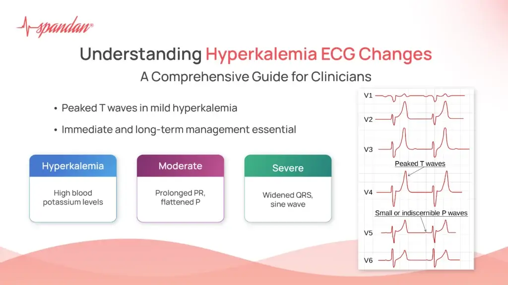 Understanding Hyperkalemia ECG Changes: A Comprehensive Guide for Clinicians