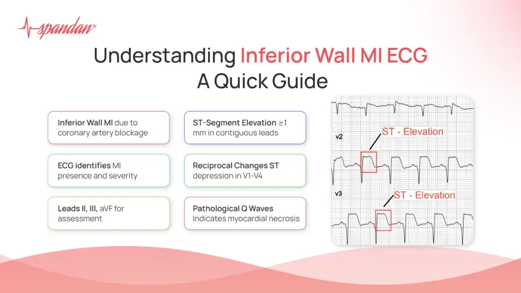 Understanding Inferior Wall MI ECG: A Quick Guide