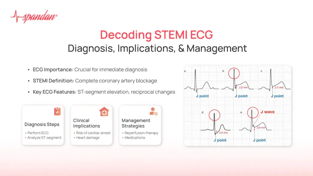 Decoding STEMI ECG: Diagnosis, Implications, and Management