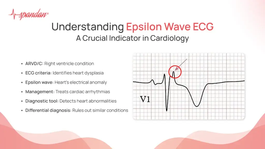 Understanding Epsilon Wave ECG: A Crucial Indicator in Cardiology
