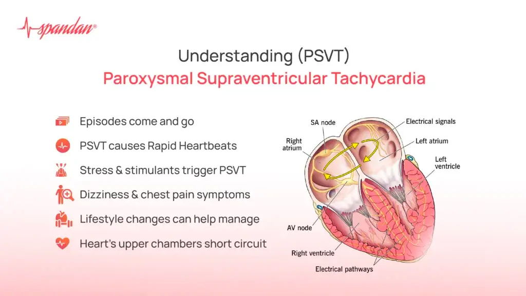 Understanding Paroxysmal Supraventricular Tachycardia (PSVT)