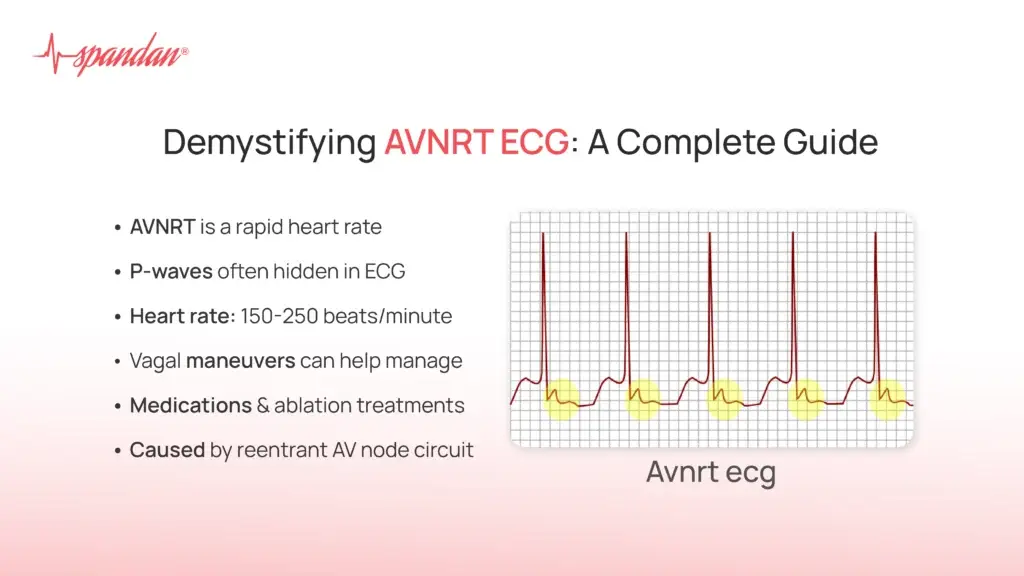 Demystifying AVNRT ECG: A Complete Guide