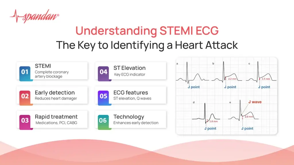 Understanding STEMI ECG: The Key to Identifying a Heart Attack