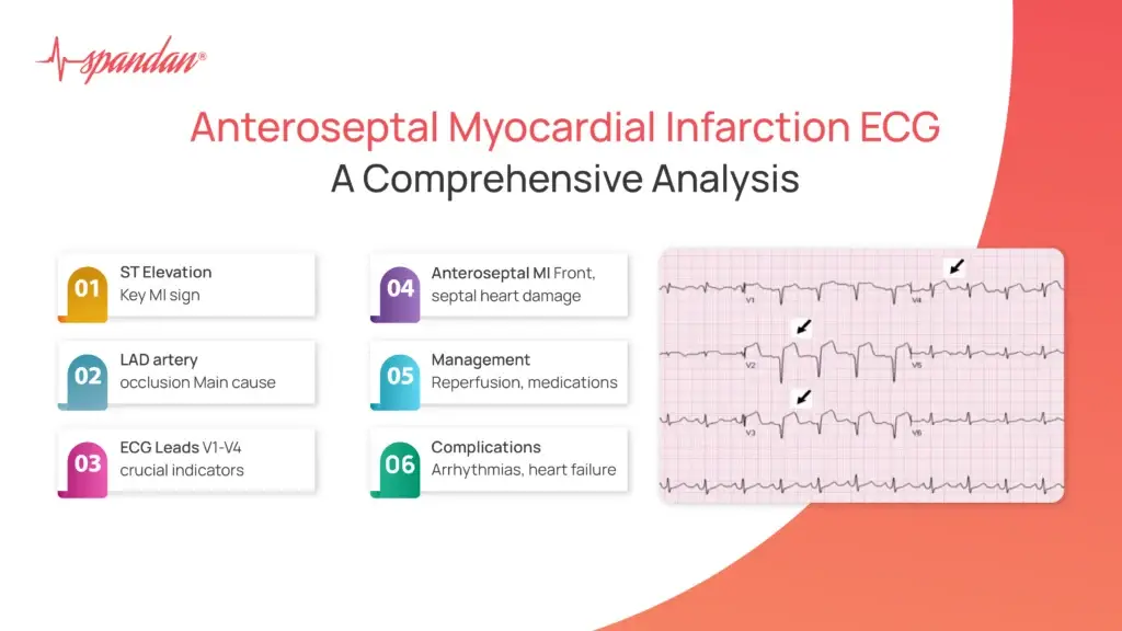Understanding Anteroseptal Myocardial Infarction ECG: A Comprehensive Analysis