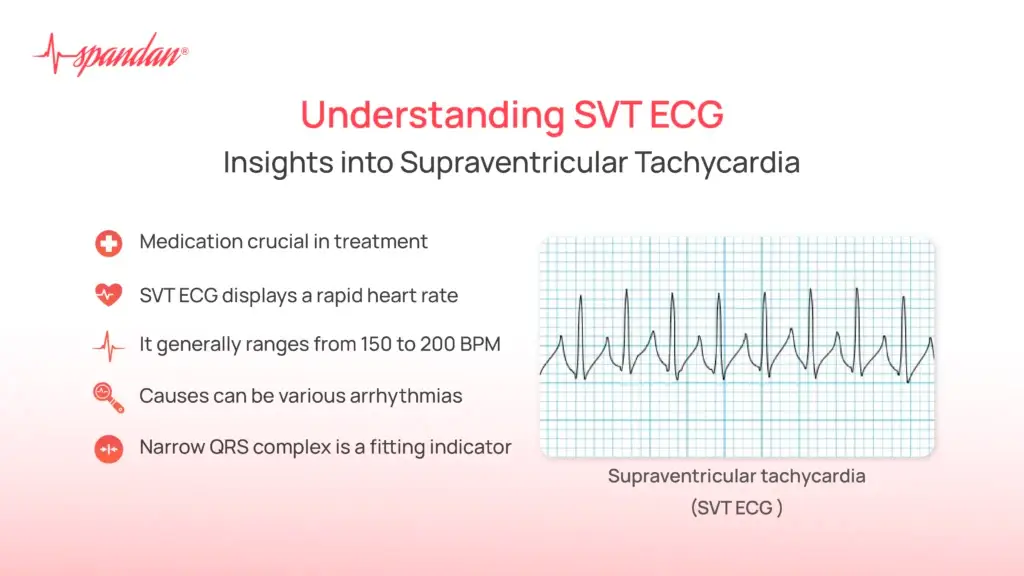 Understanding SVT ECG: Insights into Supraventricular Tachycardia