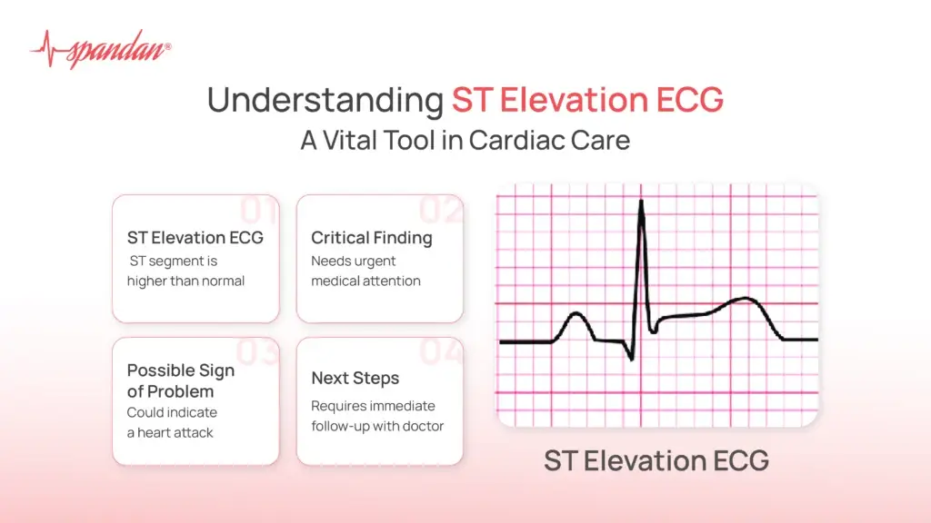 Understanding ST Elevation ECG: A Vital Tool in Cardiac Care