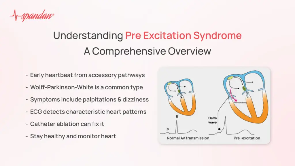 Understanding Pre Excitation Syndrome: A Comprehensive Overview