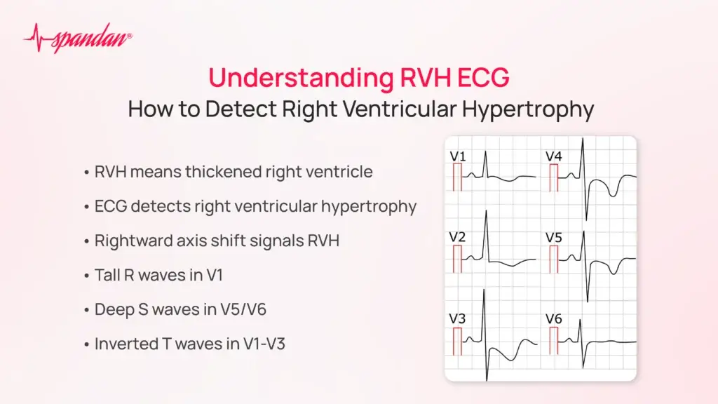 Understanding RVH ECG: How to Detect Right Ventricular Hypertrophy