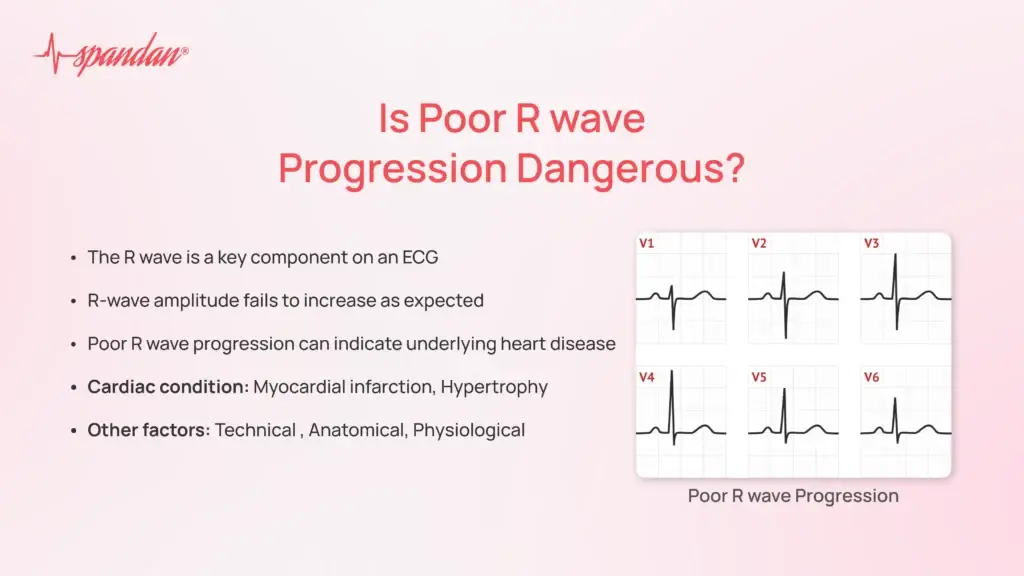 Is Poor R wave Progression Dangerous?