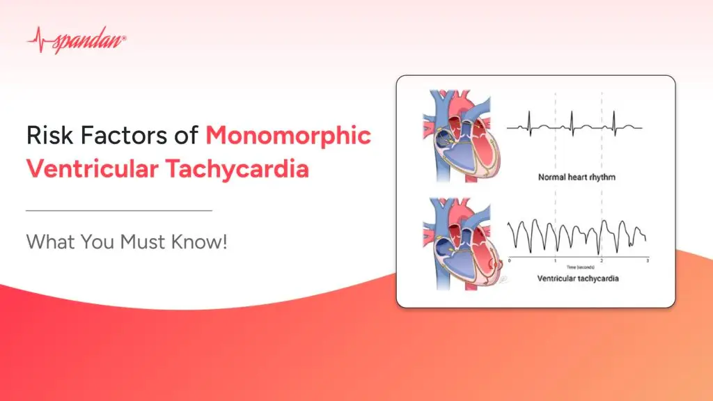 Risk Factors of Monomorphic Ventricular Tachycardia: What You Must Know